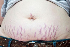 Kenali Penyakit Stretch Mark Serta Cara Menghilangkannya