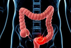 Mengenal Lebih Jauh Penyebab, Gejala Serta Cara Mengatasi Sindrom Iritasi Usus Besar