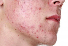 6 Cara Jitu Menghilangkan Jerawat Batu dengan Benar dan Efektif