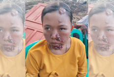 Ketika Kemiskinan Mengikat, Sri Wahyuni Warga Lubuk Sanai III Hanya Bisa Pasrah dengan Derita di Wajahnya