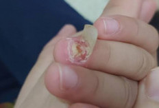 Terkait Kesehatan, Hubungan Sosial Serta Hoki, Ini Makna Mimpi Kuku Copot