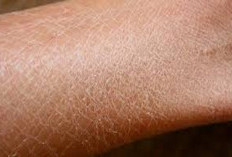 7 Cara untuk Mengatasi  Kulit Kering dan Bersisik