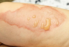 Perhatikan dan Praktekan! Begini 7 Metode untuk Mengatasi Kulit yang Melepuh karena Setrika Panas