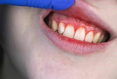 Gusi Anda Turun Dan Terasa Nyeri, Ini Faktor Penyebab Serta Cara Mengatasinya 