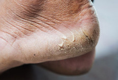 Wajib Coba, Begini Tips Mengobati Kaki Pecah-pecah, Menggunakan Obat Alami Yang Bisa Anda Lakukan