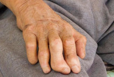 Puskesmas Suka Makmur Tangani Kasus Kusta di Bengkulu Utara