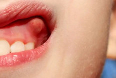 Gusi Anda Bengkak Di Sertai Nyeri? Begini Tips Mengobatinya 