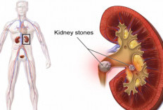 Wajib Dicoba, Begini Cara Menghancurkan Batu Ginjal Yang Jarang Diketahui