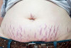 Kenali Penyakit Stretch Mark Serta Cara Menghilangkannya