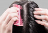 Pusing Dengan Rambut Berketombe! Ini 8 Tips Untuk Mengatasi Ketombe yang Bisa Dicoba di Rumah