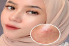 Stop Ikut-Ikutan Trend ! Kenali, Ini Ciri-Ciri SkinCare Yang Tidak Cocok Dengan Kulit Anda;