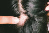 Pusing Lihat Kepala Sudah Mulai Botak Karena Rambut Rontok ? Ini 6 Cara Ampuh Mencegah Rambut Rontok Bagi Pria