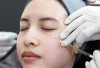 Sebelum Menyuntikkannya, Wajib Tahu Resiko Pemasangan Botox Di Wajah,Bagi Kesehatan